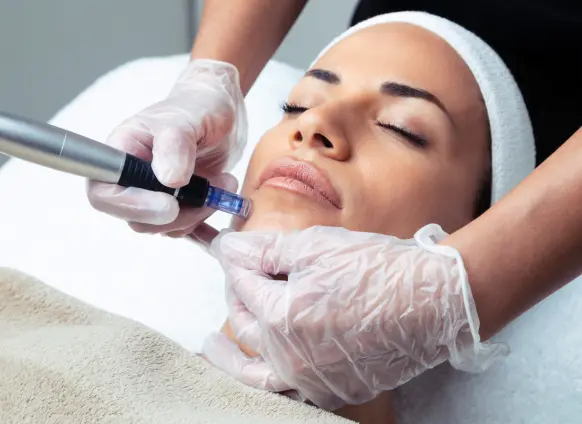 Microneedling
