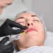 Lip Fillers in oakville