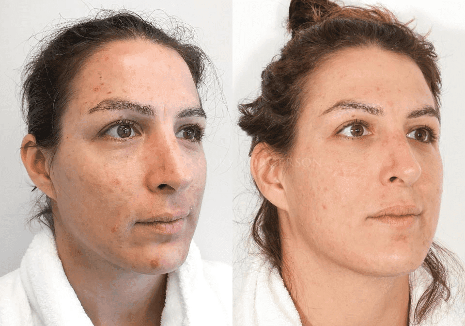 Microneedling for Skin Texture Improvement