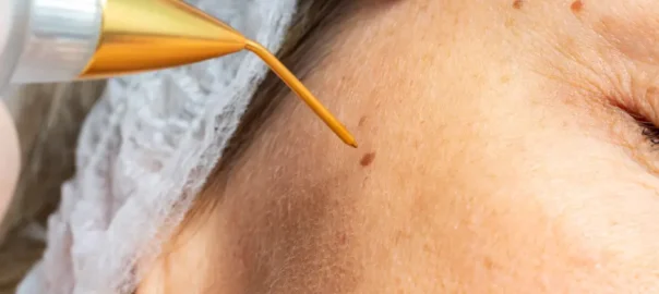 Skin Tag Removal Near Me