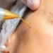 Skin Tag Removal Near Me
